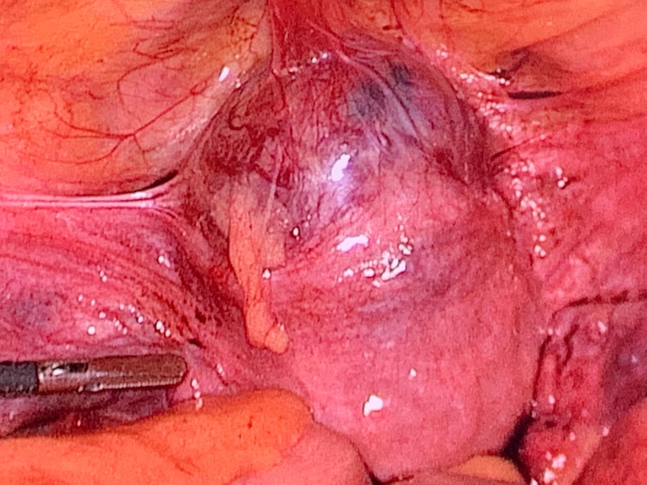 High Risk Pregnancy