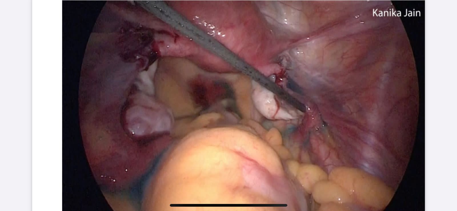 Reversal of Sterilization