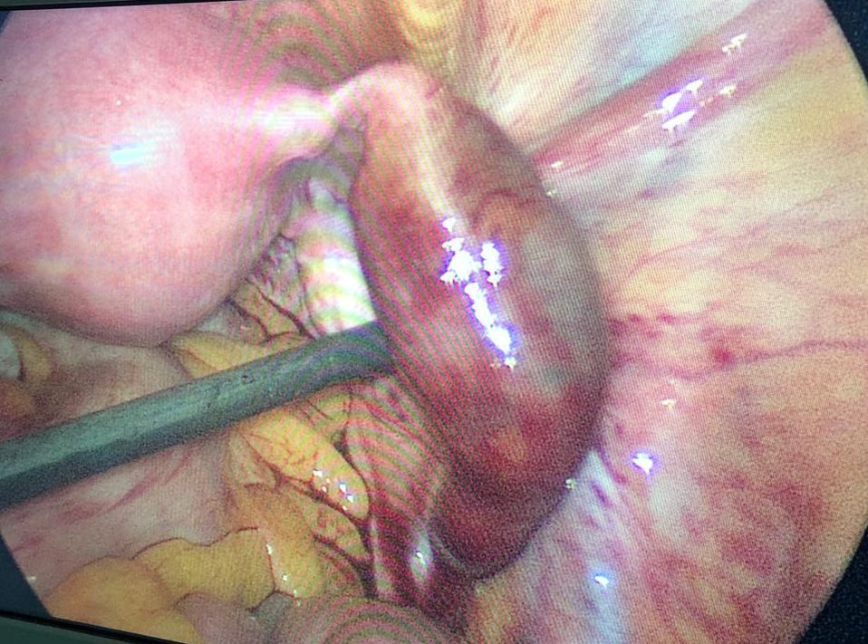 Reversal of Sterilization